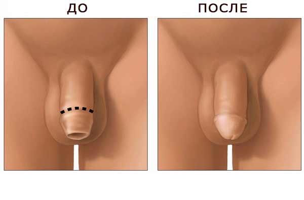 Обрезание крайней плоти у мужчин: фото до и после. Случаи из практики